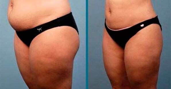 metode za mršavljenje za 10 kilograma u mjesec dana